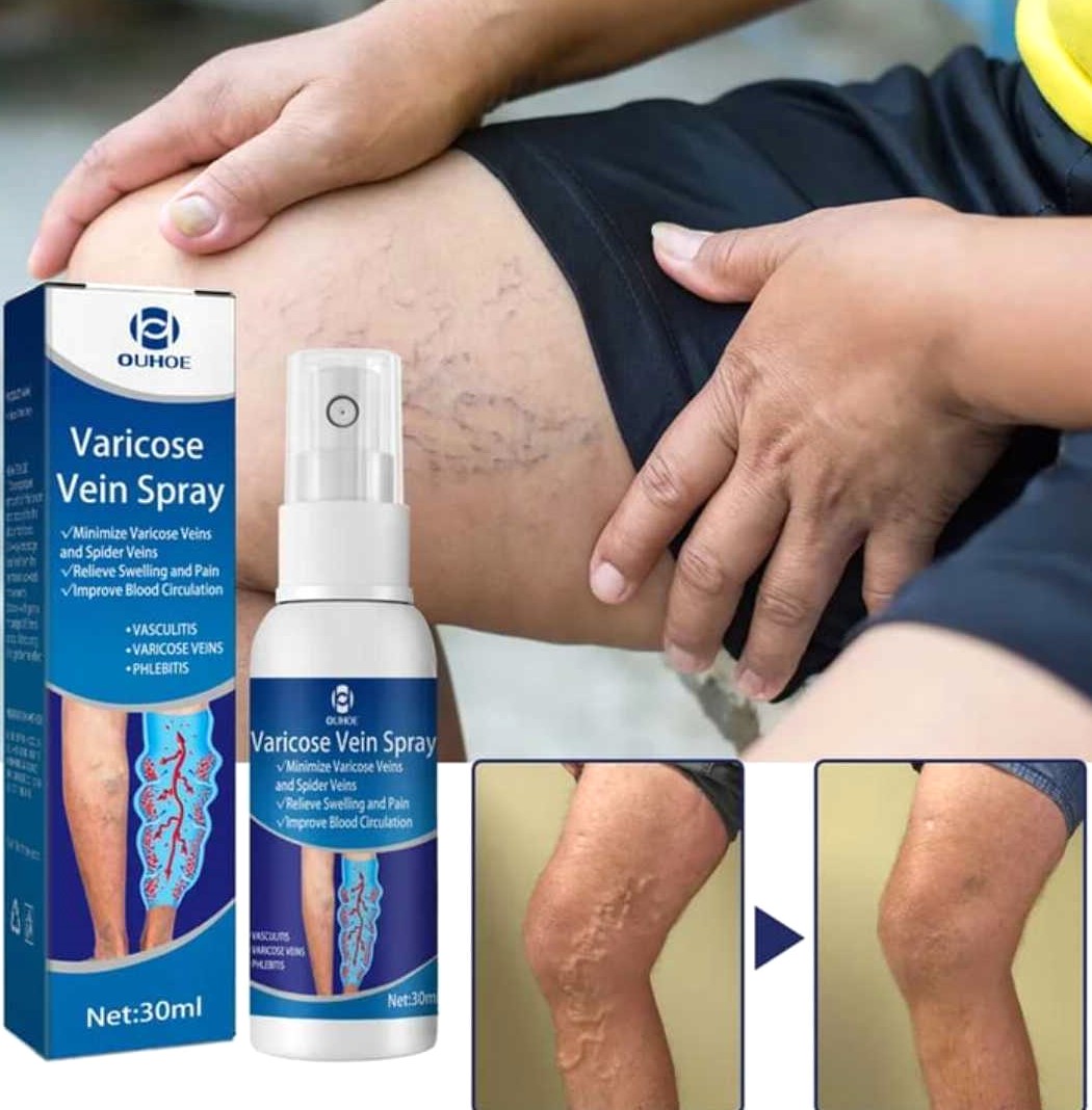 Varicose Vein Treatment Spray