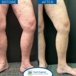 Varicose Vein Treatment Spray